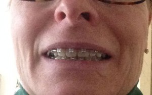 Adult Braces